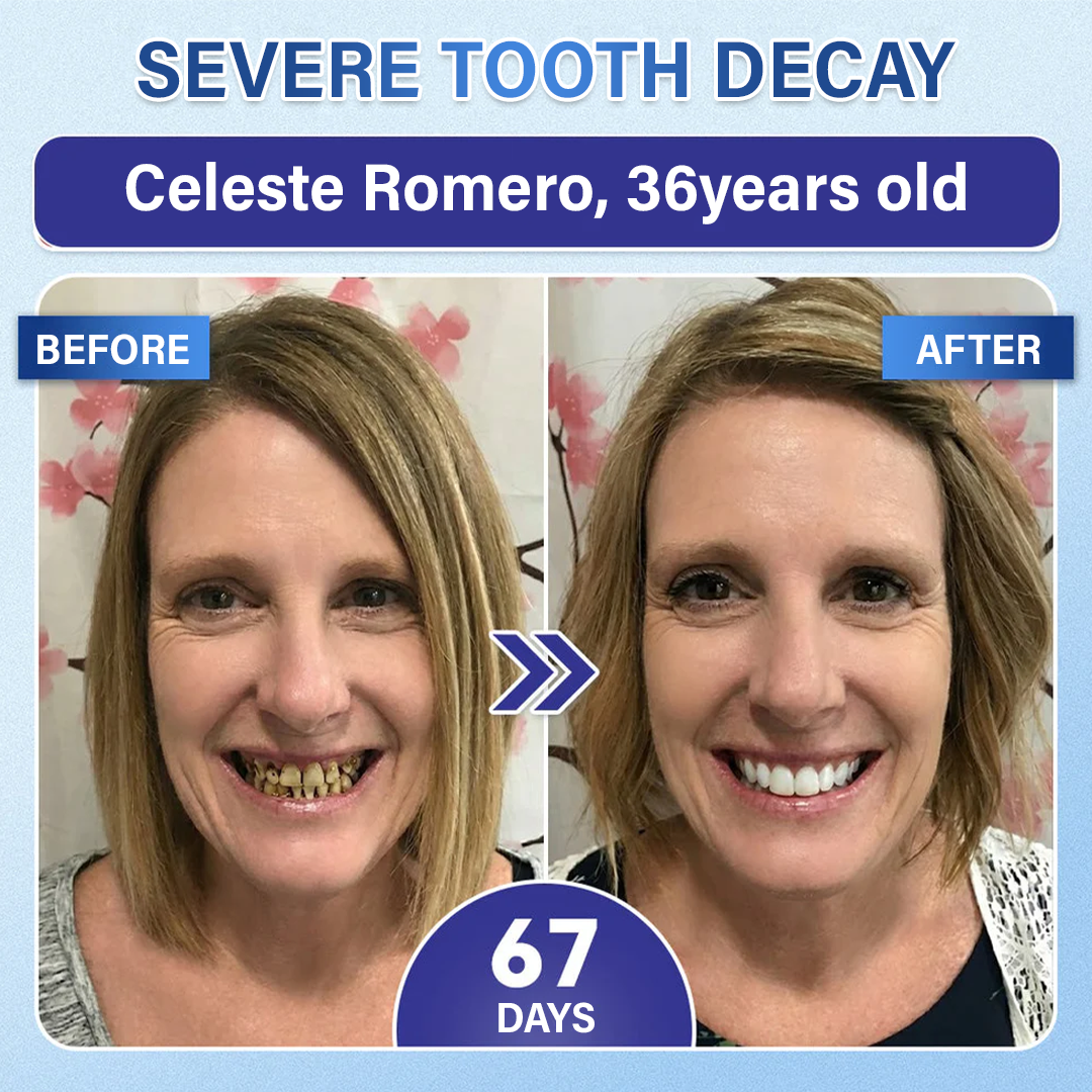 Tooth & Gum Care Fast-Dissolving Microneedle Patch✨ (𝟓-𝐢𝐧-𝟏 💎 𝐑𝐞𝐛𝐮𝐢𝐥𝐝 𝐄𝐧𝐚𝐦𝐞𝐥 & 𝐃𝐞𝐧𝐭𝐢𝐧 • 𝐒𝐭𝐫𝐞𝐧𝐠𝐭𝐡𝐞𝐧 𝐆𝐮𝐦𝐬 • 𝐄𝐫𝐚𝐝𝐢𝐜𝐚𝐭𝐞 𝐓𝐚𝐫𝐭𝐚𝐫 & 𝐎𝐝𝐨𝐫 • 𝐖𝐡𝐢𝐭𝐞𝐧𝐢𝐧𝐠 • 𝐒𝐭𝐨𝐩 𝐓𝐨𝐨𝐭𝐡 𝐒𝐞𝐧𝐬𝐢𝐭𝐢𝐯𝐢𝐭𝐲)