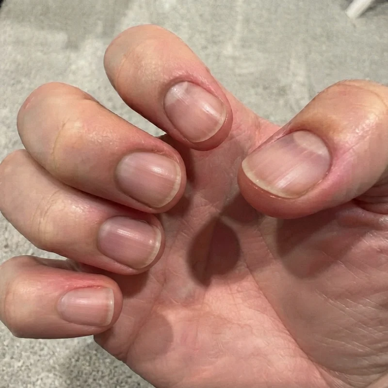 After consistent nail care routine