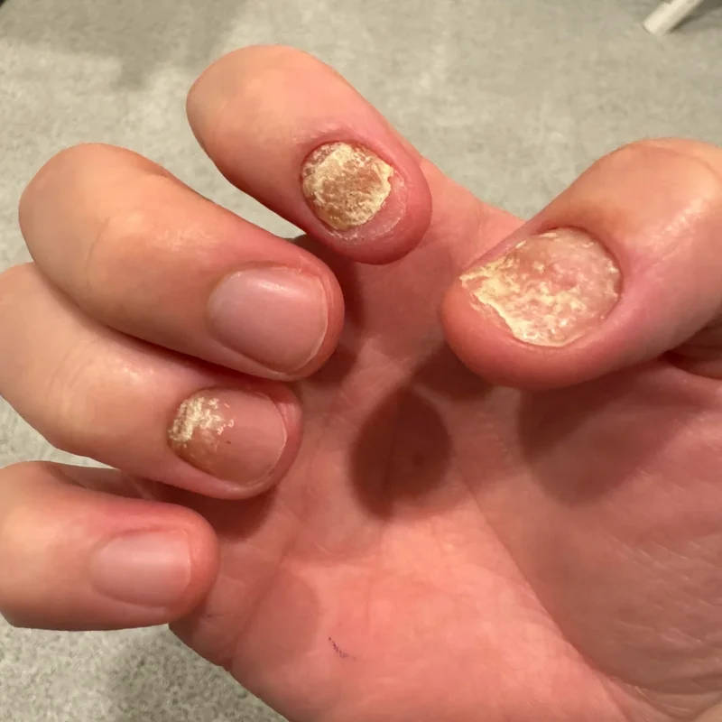 Before using Advanced Nail Care