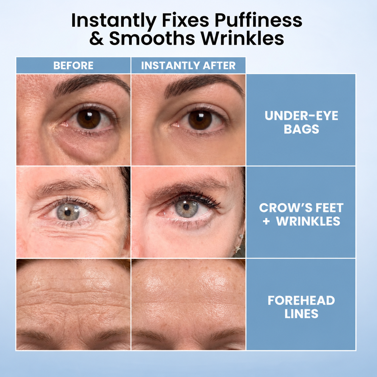 Before and after examples showing the appearance of under-eye bags, crow's feet and forehead lines