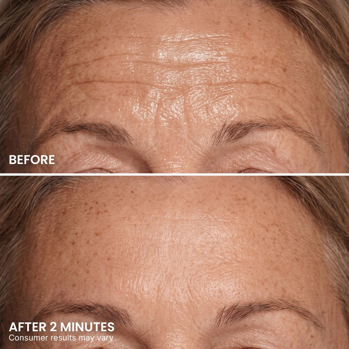 Before and after example showing the appearance of forehead lines