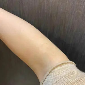 Customer forearm after using scar gel