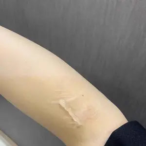 Customer forearm before using scar gel