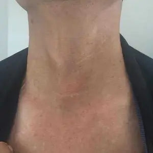 Customer neck after using scar gel