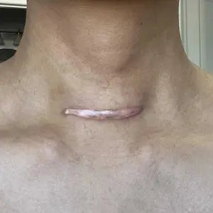 Customer neck scar before using scar gel