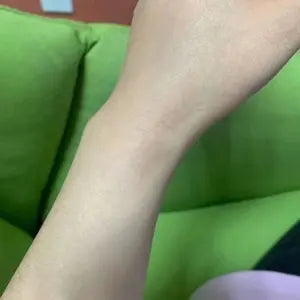 Customer wrist after using scar gel