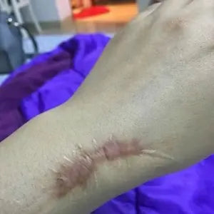 Customer wrist scar before using scar gel