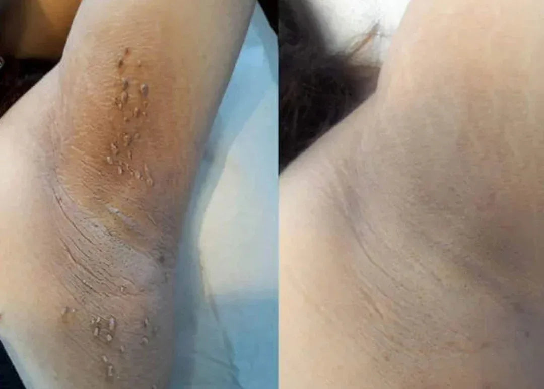 Before-and-after appearance example in an underarm area